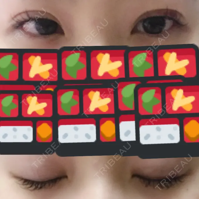 二重埋没 湘南美容クリニック 東京蒲田院 DAY 9 メイン用