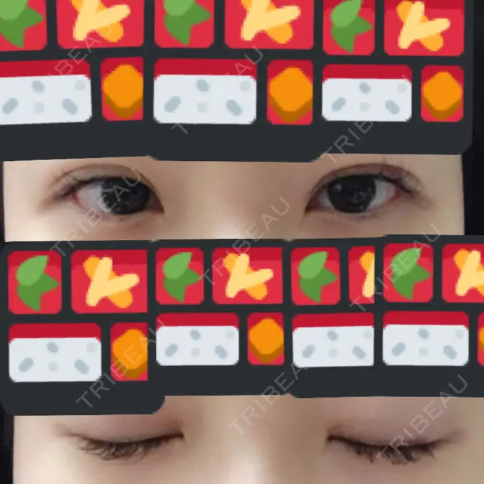 二重埋没 湘南美容クリニック 東京蒲田院 AFTER メイン用