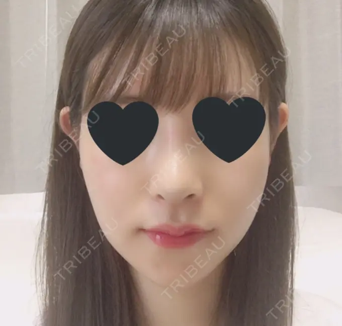 バッカルファット除去 / 脂肪吸引（顔） / ヒアルロン酸注入（あご） / レディエッセ注入（あご） / ボトックス（エラ・小顔） / その他（輪郭） エートップ美容整形外科 AFTER メイン用