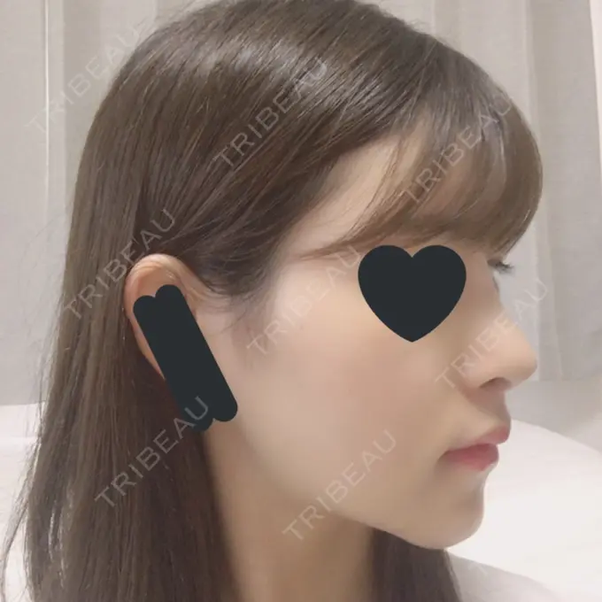 バッカルファット除去 / 脂肪吸引（顔） / ヒアルロン酸注入（あご） / レディエッセ注入（あご） / ボトックス（エラ・小顔） / その他（輪郭） エートップ美容整形外科 DAY 13 メイン用