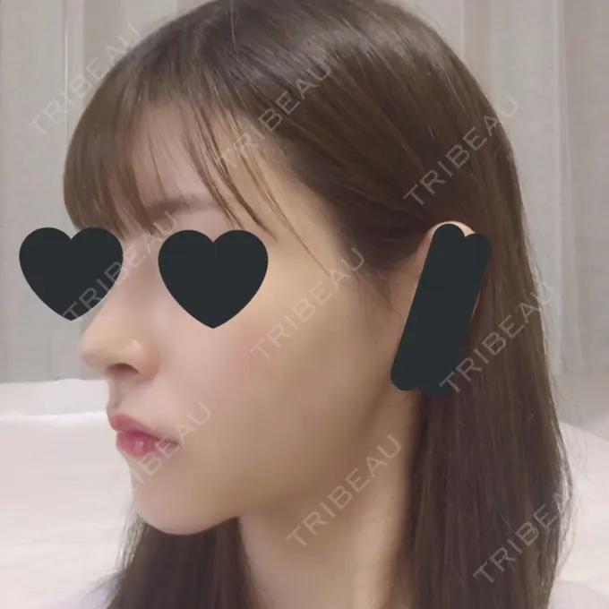 バッカルファット除去 / 脂肪吸引（顔） / ヒアルロン酸注入（あご） / レディエッセ注入（あご） / ボトックス（エラ・小顔） / その他（輪郭） エートップ美容整形外科 DAY 13 メイン用