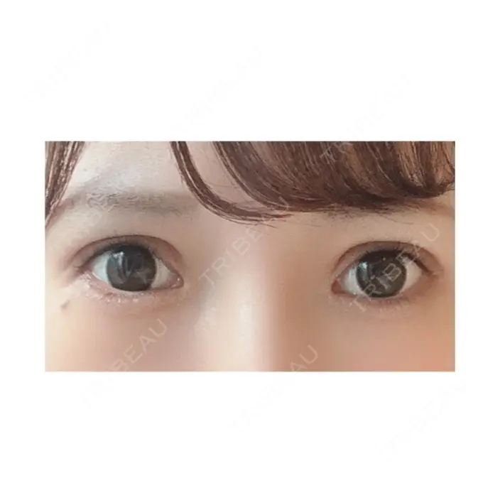 二重切開 / 目頭切開 / 眼瞼下垂（切開） RG整形外科（旧リオン整形外科） AFTER メイン用