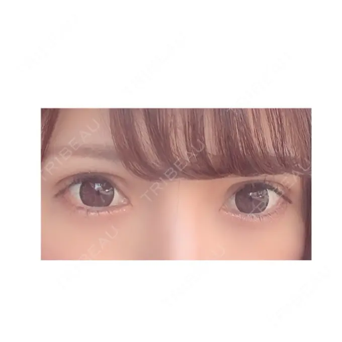 二重切開 / 目頭切開 / 眼瞼下垂（切開） RG整形外科（旧リオン整形外科） DAY 72 メイン用