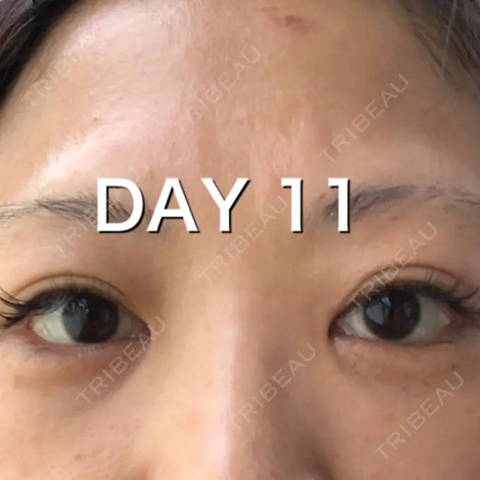 クマ治療 / タレ目形成・グラマラスライン（切開） / その他（目元） BIANCA銀座 DAY 11 メイン用
