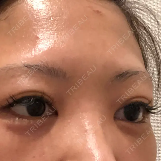 クマ治療 / タレ目形成・グラマラスライン（切開） / その他（目元） BIANCA銀座 DAY 11 メイン用