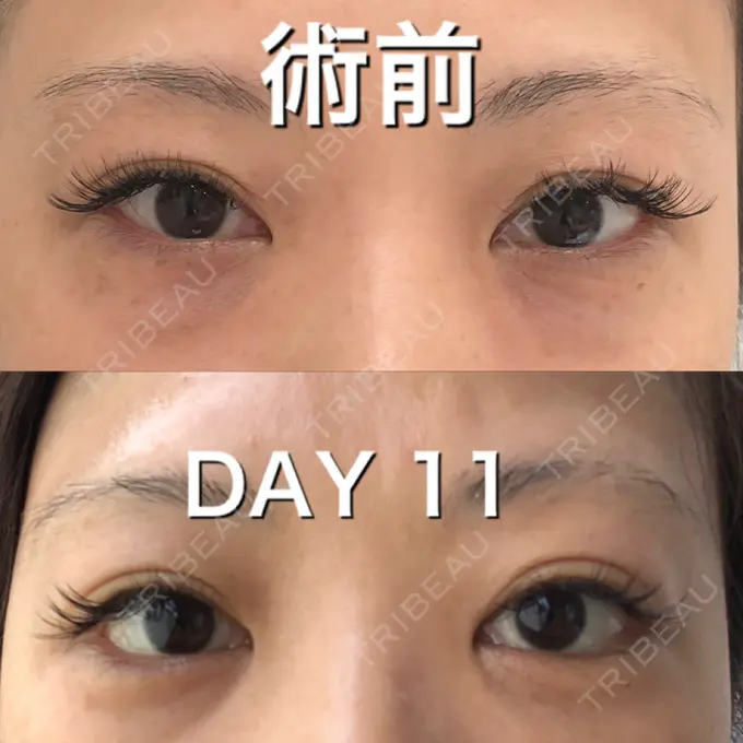 クマ治療 / タレ目形成・グラマラスライン（切開） / その他（目元） BIANCA銀座 DAY 11 メイン用