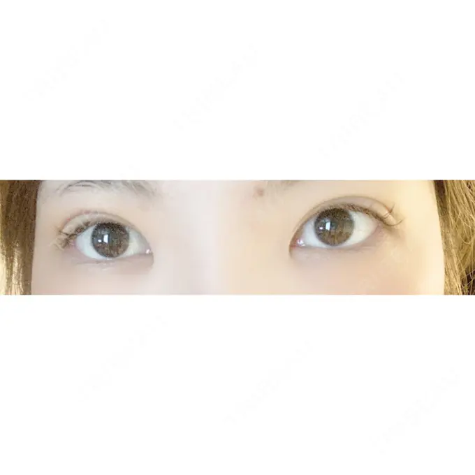 二重埋没 / 上まぶたの脂肪取り 札幌中央クリニック DAY 15 メイン用