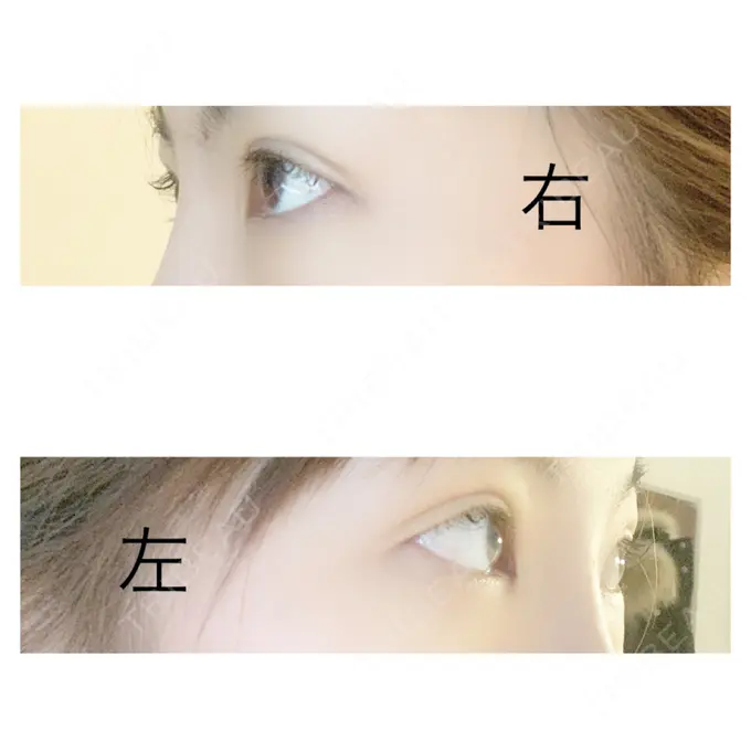二重埋没 / 上まぶたの脂肪取り 札幌中央クリニック DAY 15 メイン用