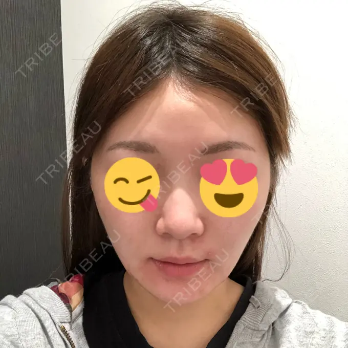 脂肪吸引（顔） / メーラーファット除去 湘南美容クリニック 秋葉原院 AFTER メイン用