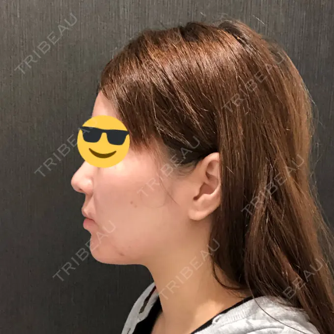 脂肪吸引（顔） / メーラーファット除去 湘南美容クリニック 秋葉原院 DAY 30 メイン用