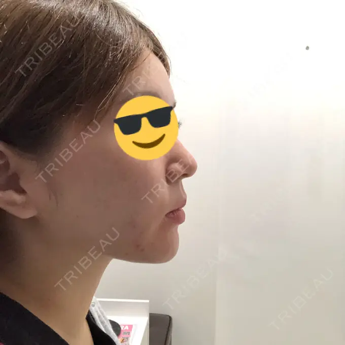 脂肪吸引（顔） / メーラーファット除去 湘南美容クリニック 秋葉原院 DAY 30 メイン用