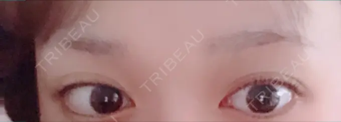 眉下切開 / その他（目元） 湘南美容クリニック 秋葉原院 AFTER メイン用