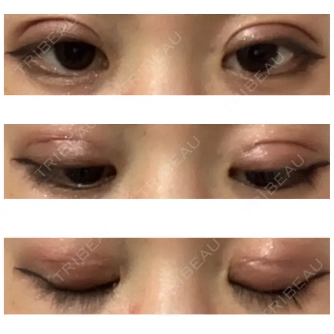 二重切開 久留米総合美容外科 DAY 56 メイン用