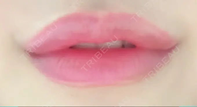 ヒアルロン酸注入（唇） ルラ美容クリニック 高田馬場院 DAY 7 メイン用