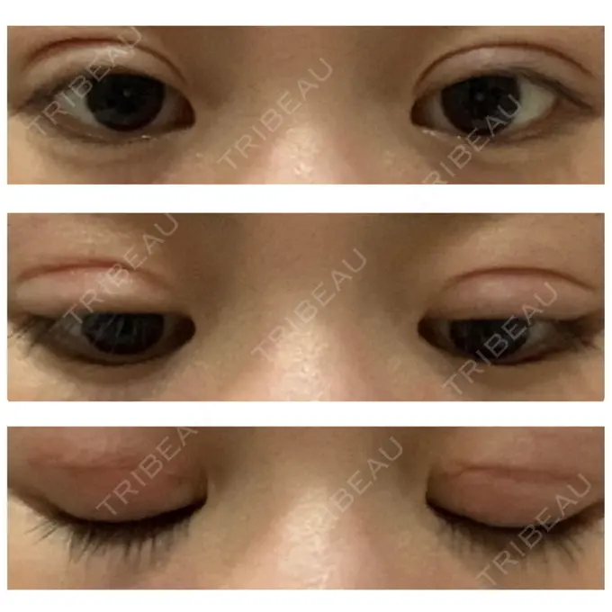 二重切開 久留米総合美容外科 DAY 56 メイン用