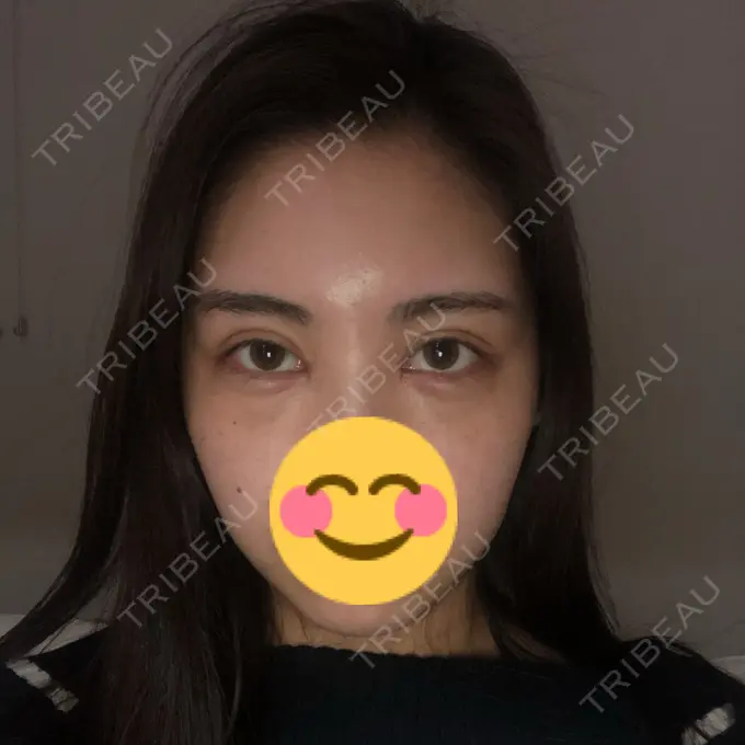 二重切開 / 目頭切開 / クマ治療 / バッカルファット除去 / 脂肪吸引（顔） / 額を丸く / 目尻切開 ヴェリテクリニック 名古屋院 DAY 19 メイン用