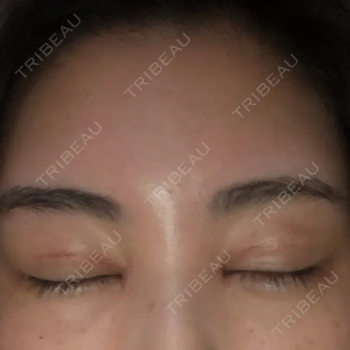 二重切開 / 目頭切開 / クマ治療 / バッカルファット除去 / 脂肪吸引（顔） / 額を丸く / 目尻切開 ヴェリテクリニック 名古屋院 DAY 19 メイン用