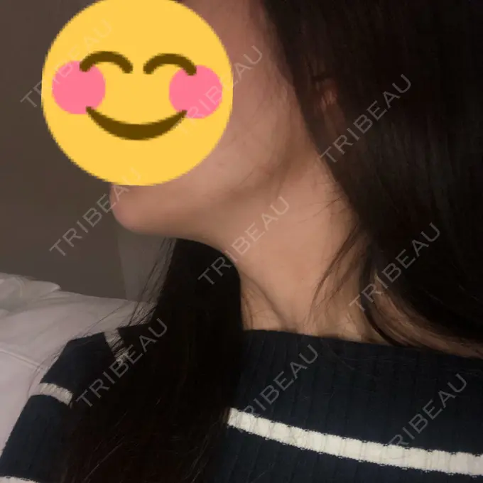 二重切開 / 目頭切開 / クマ治療 / バッカルファット除去 / 脂肪吸引（顔） / 額を丸く / 目尻切開 ヴェリテクリニック 名古屋院 DAY 19 メイン用