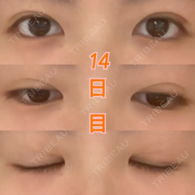 二重埋没 湘南美容クリニック 東京蒲田院 DAY 14 メイン用