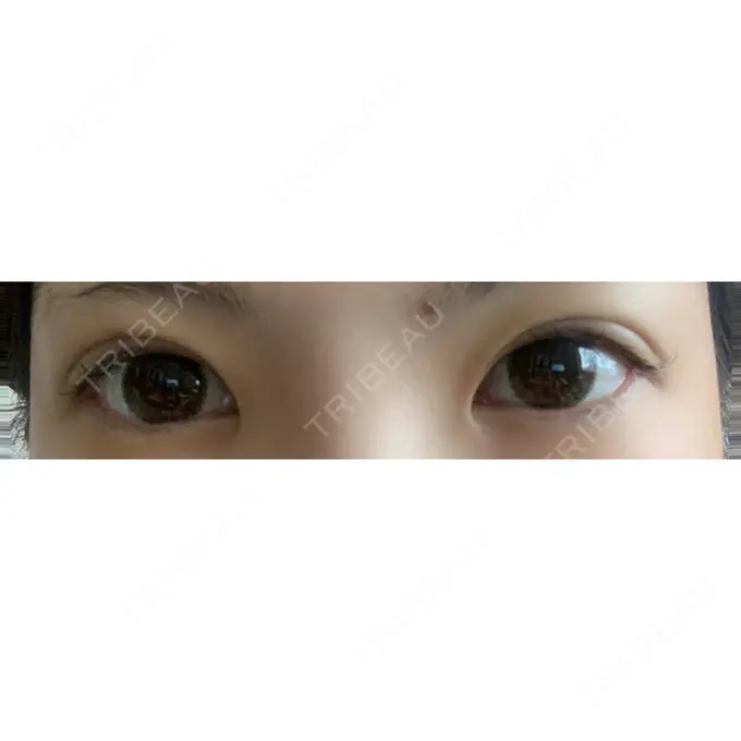 二重埋没 / 上まぶたの脂肪取り 札幌中央クリニック DAY 18 メイン用