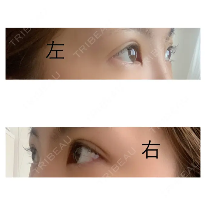 二重埋没 / 上まぶたの脂肪取り 札幌中央クリニック DAY 18 メイン用