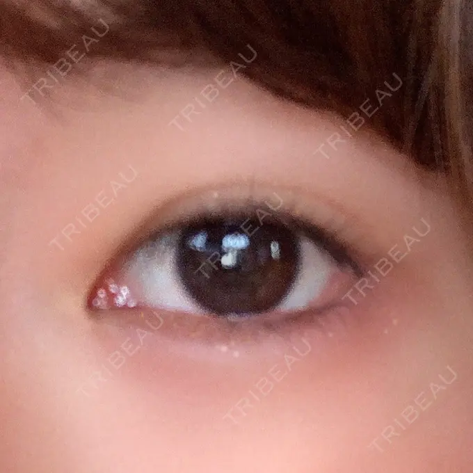 タレ目形成・グラマラスライン（切開） / ボトックス（タレ目） TCB東京中央美容外科 宇都宮院 DAY 0 メイン用