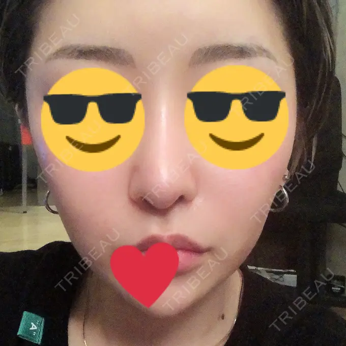 隆鼻術 / 軟骨移植 / 骨切幅寄せ / 鼻尖縮小 / その他（鼻） 韓国BBクリニック（旧 シンミアン形成外科） AFTER メイン用
