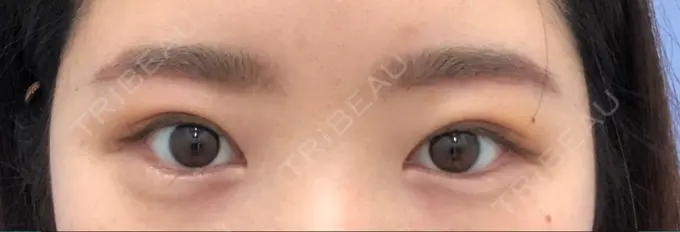 上まぶたの脂肪取り / 眉下切開 湘南美容クリニック 秋葉原院 AFTER メイン用