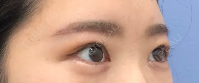 上まぶたの脂肪取り / 眉下切開 湘南美容クリニック 秋葉原院 DAY 7 メイン用