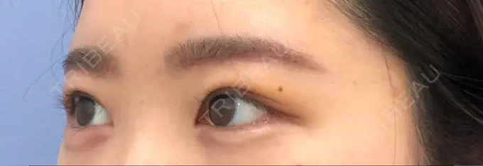 上まぶたの脂肪取り / 眉下切開 湘南美容クリニック 秋葉原院 DAY 7 メイン用