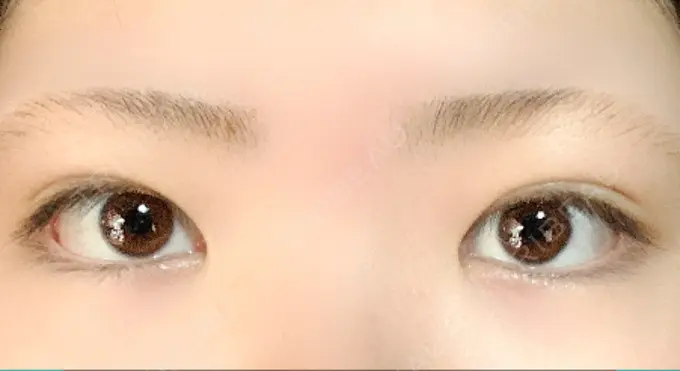 二重埋没 / 上まぶたの脂肪取り TCB東京中央美容外科 新横浜院 DAY 35 メイン用