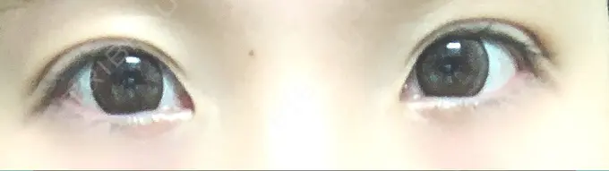 二重埋没 湘南美容クリニック 札幌院 AFTER メイン用