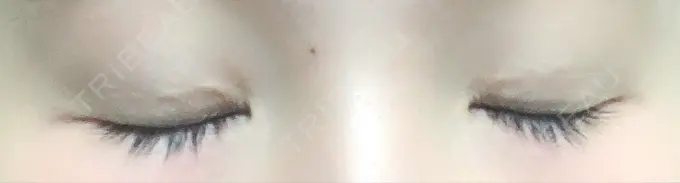 二重埋没 湘南美容クリニック 札幌院 DAY 69 メイン用