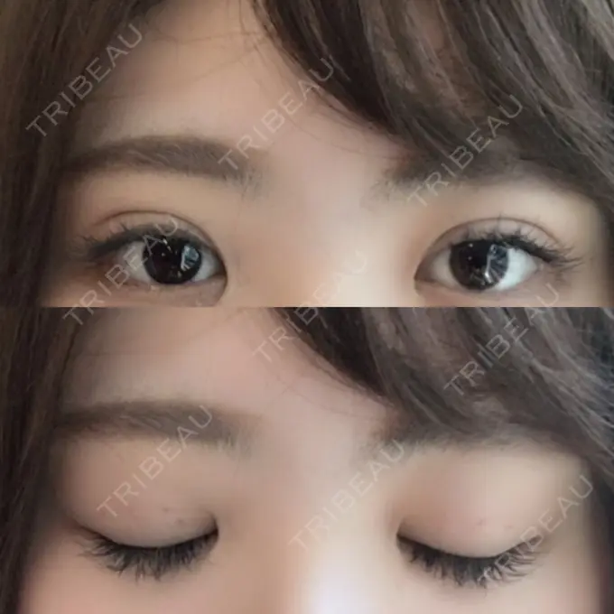 二重埋没 共立美容外科 柏院 AFTER メイン用