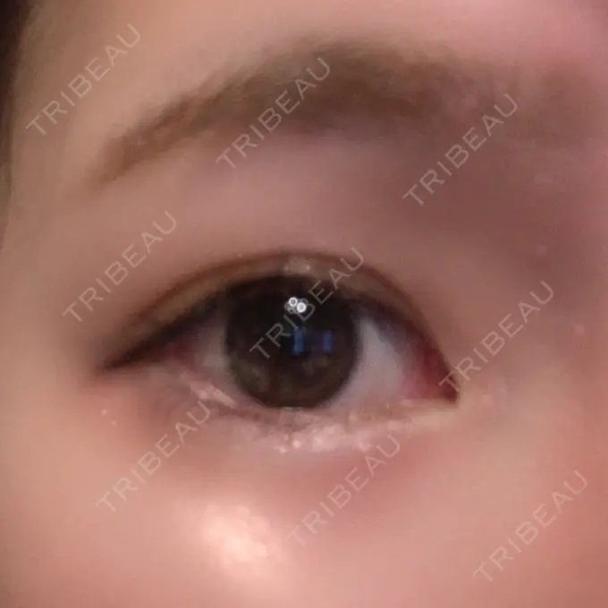 タレ目形成・グラマラスライン（切開） / ボトックス（タレ目） TCB東京中央美容外科 宇都宮院 DAY 2 メイン用