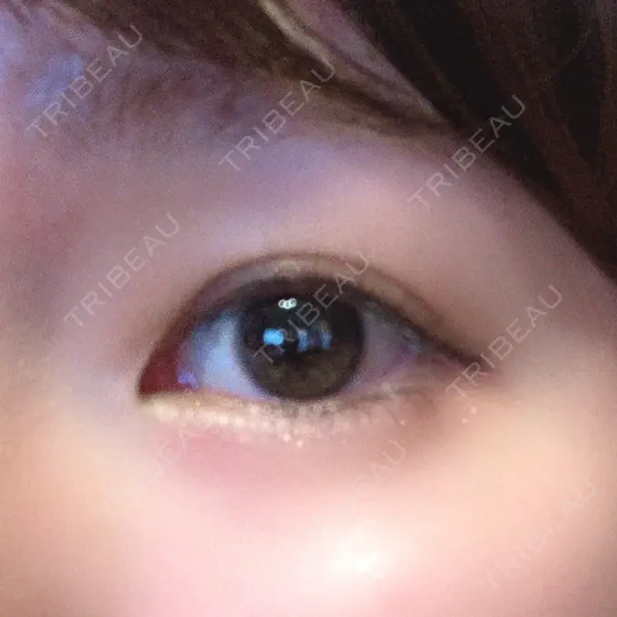 タレ目形成・グラマラスライン（切開） / ボトックス（タレ目） TCB東京中央美容外科 宇都宮院 DAY 2 メイン用