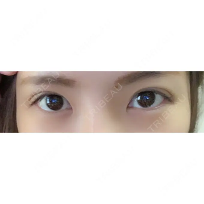 二重埋没 / 上まぶたの脂肪取り 札幌中央クリニック AFTER メイン用