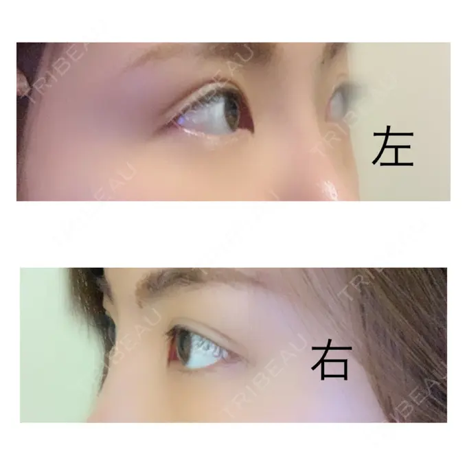 二重埋没 / 上まぶたの脂肪取り 札幌中央クリニック DAY 21 メイン用