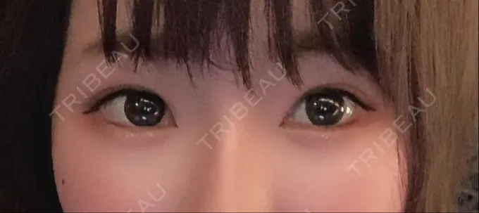 タレ目形成・グラマラスライン（切開） / ボトックス（タレ目） TCB東京中央美容外科 宇都宮院 AFTER メイン用