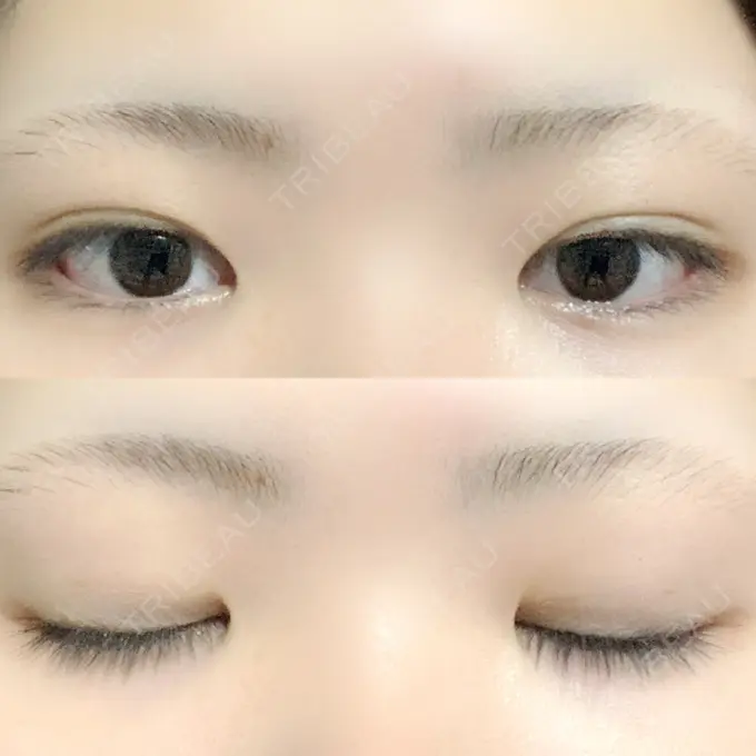 二重埋没 / 上まぶたの脂肪取り TCB東京中央美容外科 新横浜院 DAY 36 メイン用