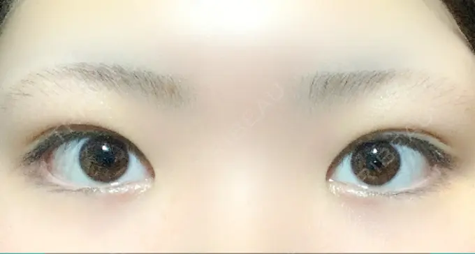 二重埋没 / 上まぶたの脂肪取り TCB東京中央美容外科 新横浜院 DAY 37 メイン用