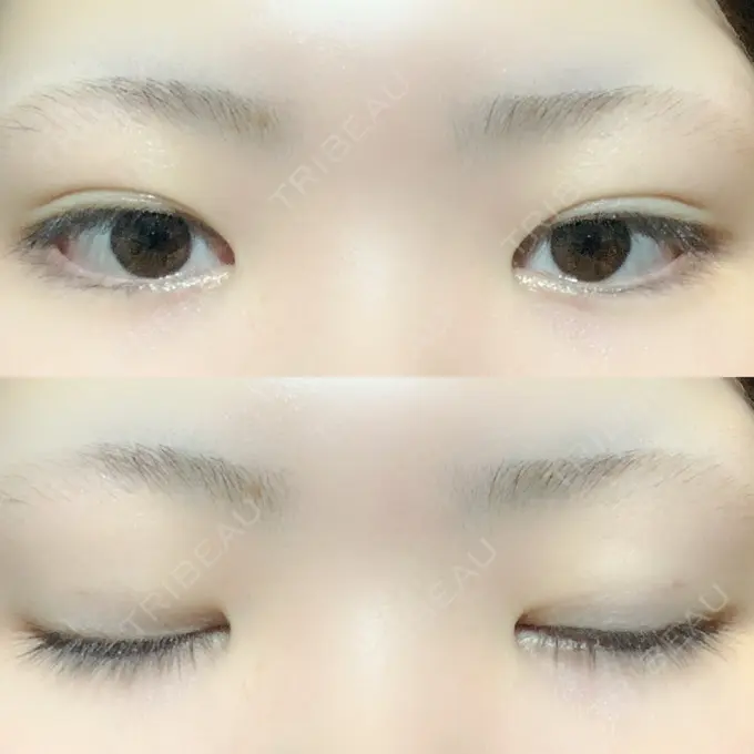 二重埋没 / 上まぶたの脂肪取り TCB東京中央美容外科 新横浜院 DAY 37 メイン用