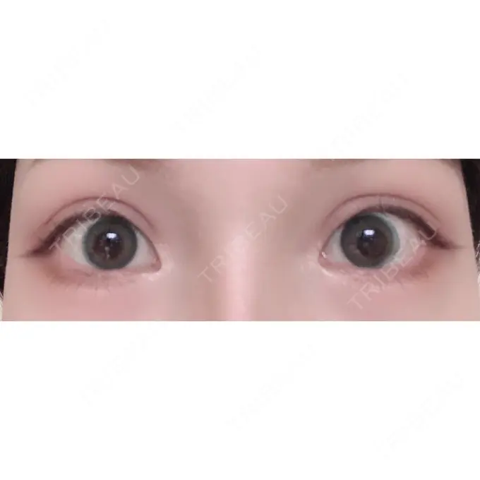 二重切開 / 目頭切開 / 上まぶたの脂肪取り / 蒙古ひだ形成 FROM B整形外科 (旧バウム整形外科) AFTER メイン用