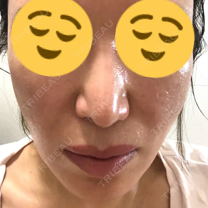 その他（目元） スノウ（Snow）整形外科 AFTER メイン用