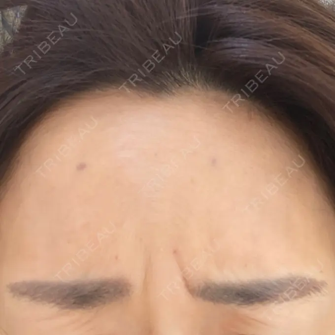 シワ取りボトックス 湘南美容クリニック 自由が丘院 DAY 2 メイン用