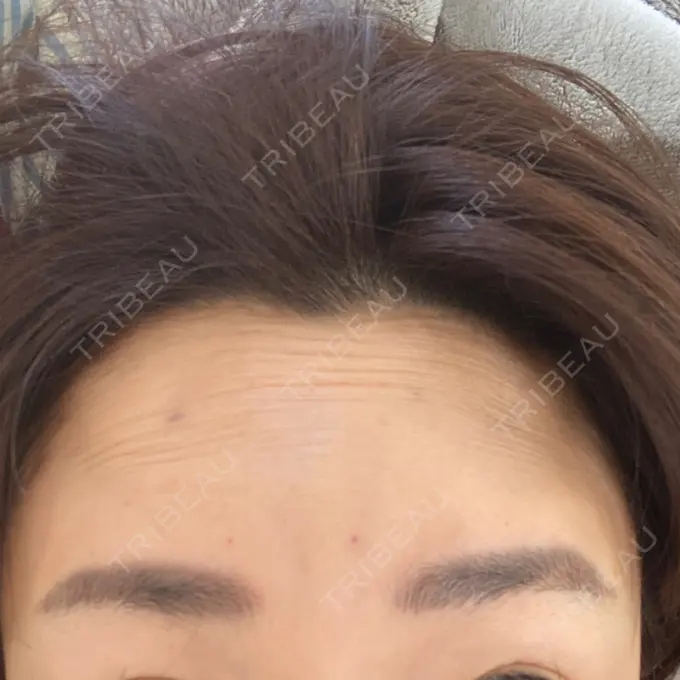 シワ取りボトックス 湘南美容クリニック 自由が丘院 DAY 2 メイン用