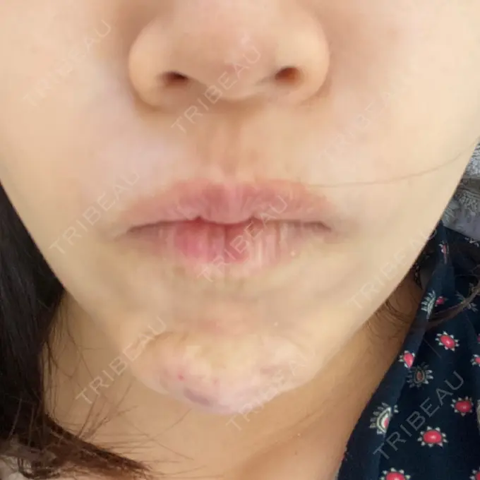 シワ取りボトックス 湘南美容クリニック 自由が丘院 DAY 2 メイン用