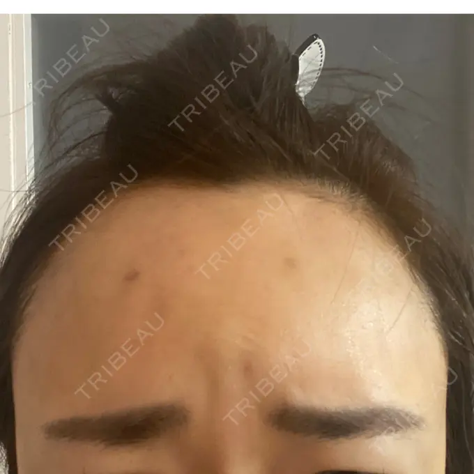 シワ取りボトックス 湘南美容クリニック 自由が丘院 DAY 3 メイン用