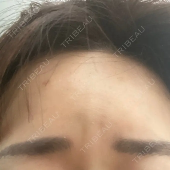 シワ取りボトックス 湘南美容クリニック 自由が丘院 AFTER メイン用