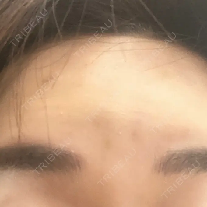 シワ取りボトックス 湘南美容クリニック 自由が丘院 DAY 4 メイン用